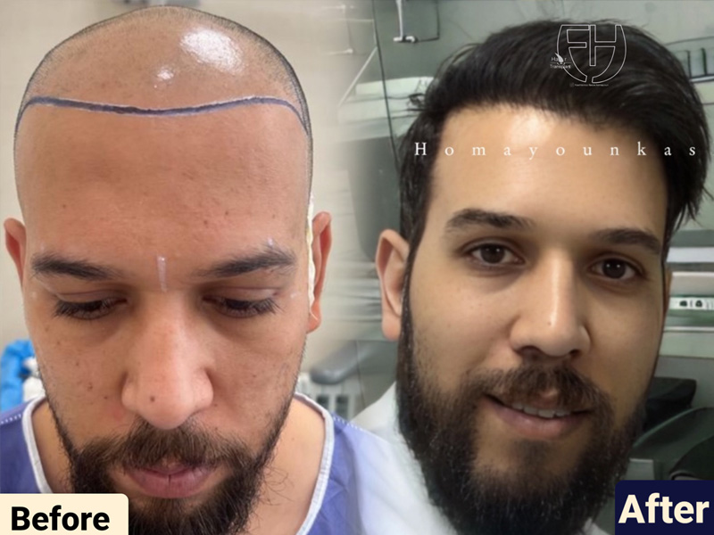 کاشت مو به روش fit و sut