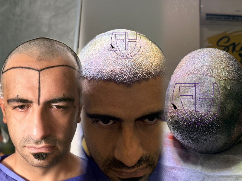 کاشت مو به روش fit و sut