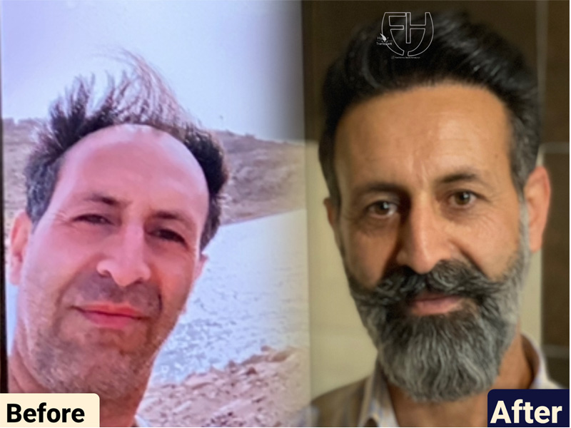 کاشت مو به روش fit