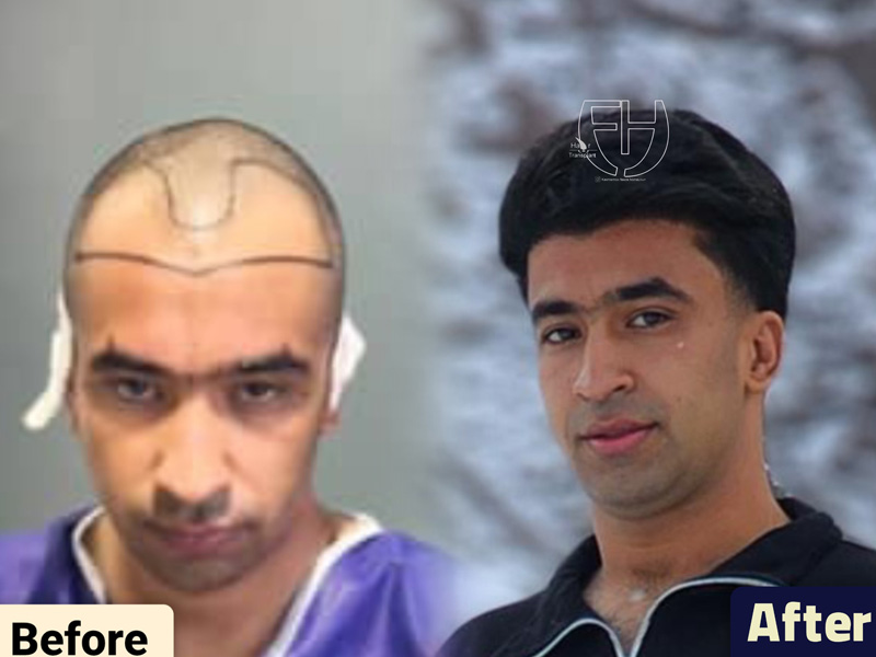 کاشت مو به روش fit