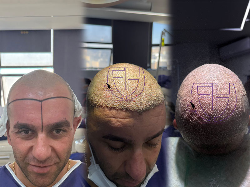 کاشت مو به روش fit