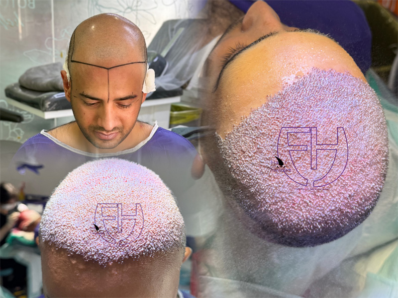 کاشت مو به روش fit و sut