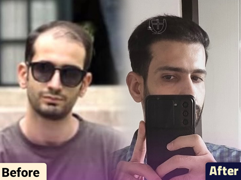کاشت مو به روش fit و sut