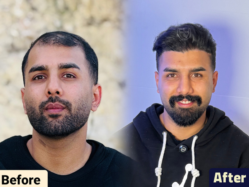 کاشت مو به روش fit و sut