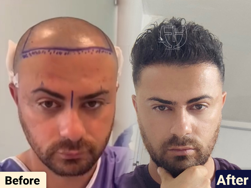 کاشت مو به روش fit و sut