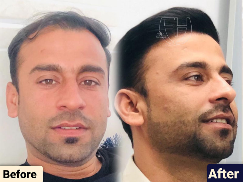 کاشت مو به روش fit