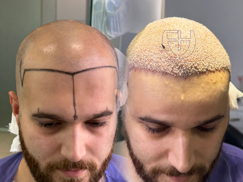 کاشت مو به روش fit و sut