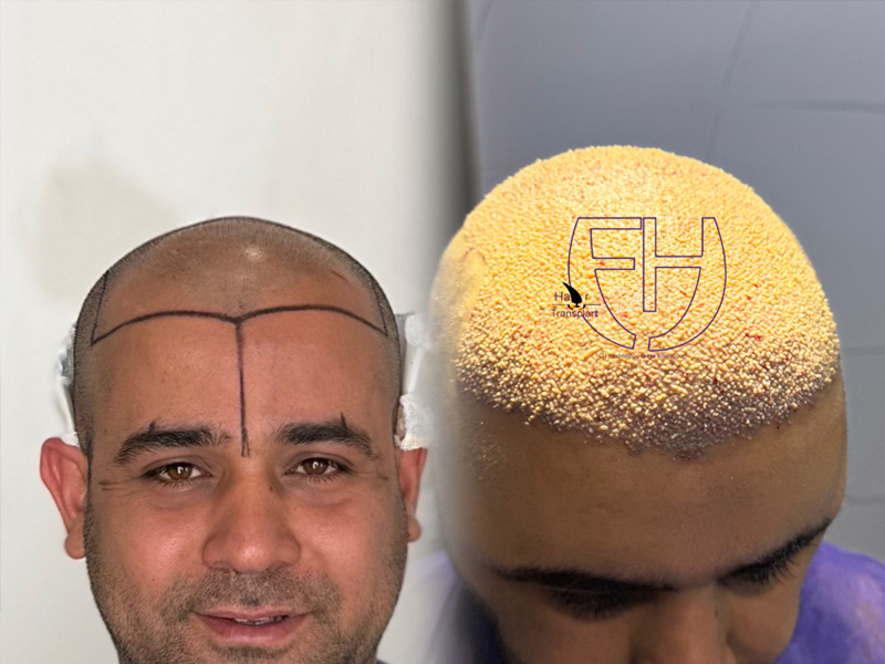 کاشت مو به روش fit و sut