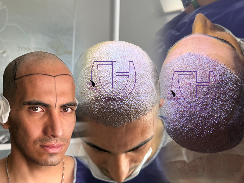 کاشت مو به روش fit