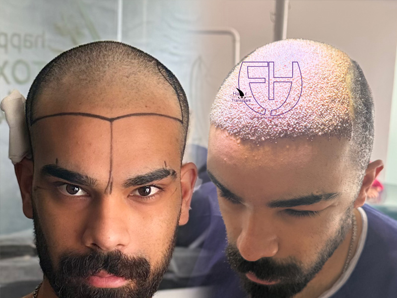 کاشت مو به روش fit