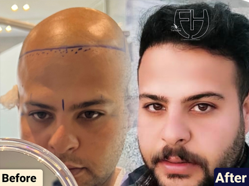 کاشت مو به روش fit و sut