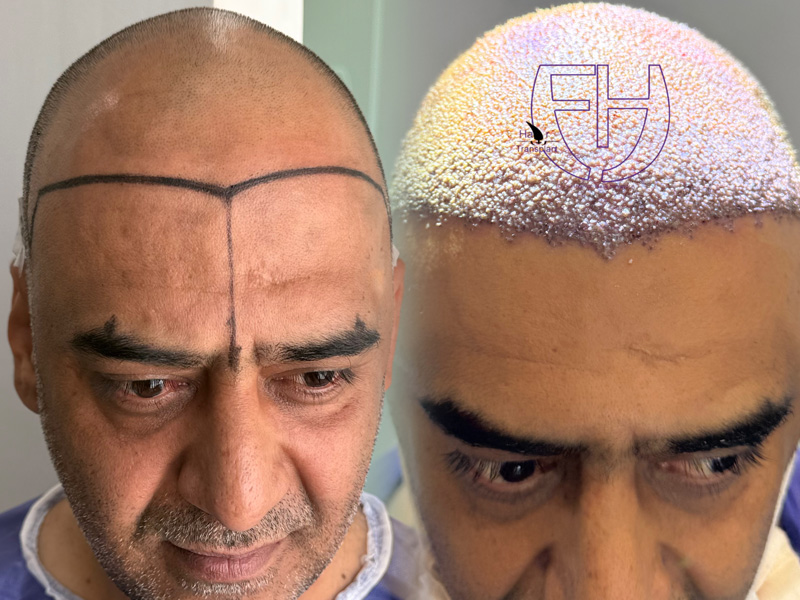 کاشت مو به روش fit و sut