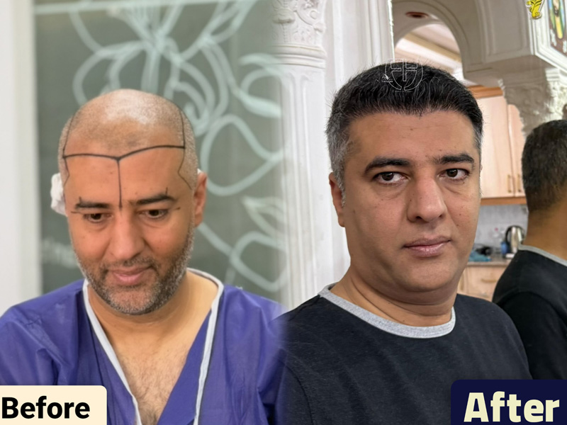 کاشت مو به روش fit و sut