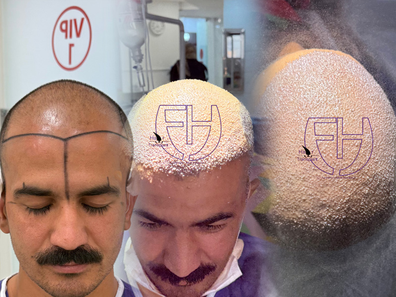 کاشت مو به روش fit و sut