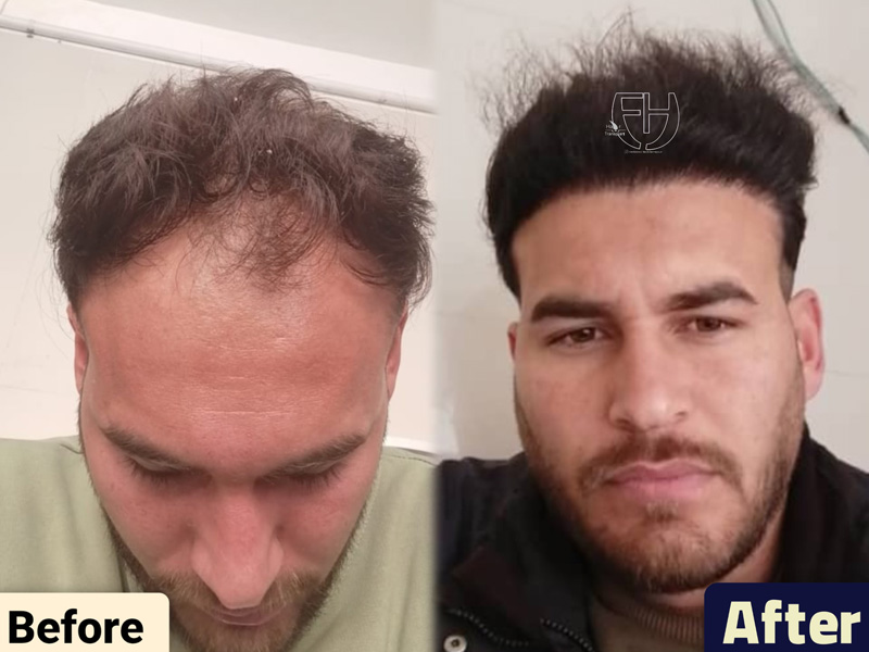 کاشت مو به روش fit و sut