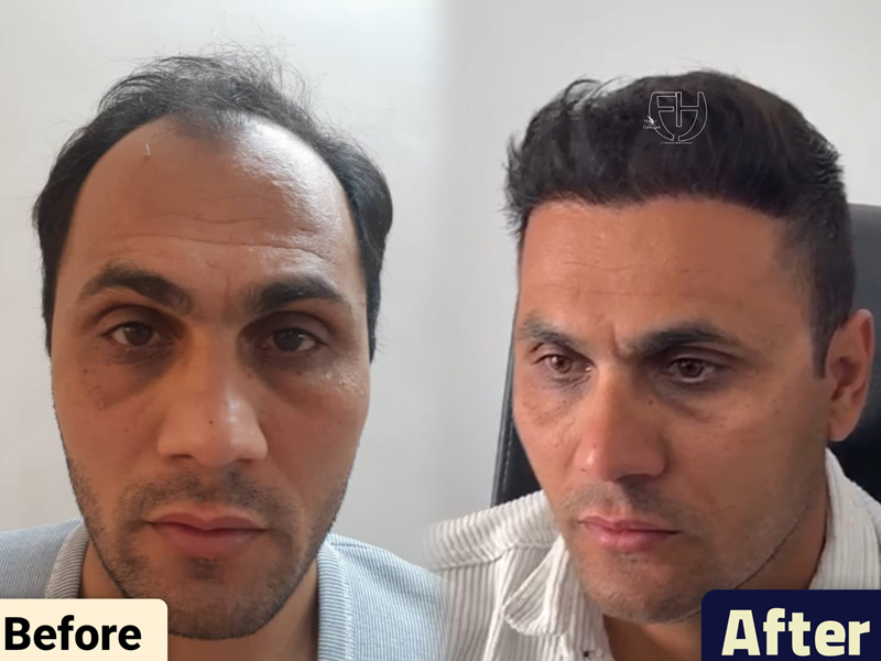 کاشت مو به روش fit
