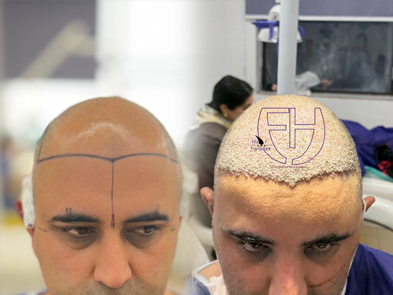 کاشت مو به روش fit و sut