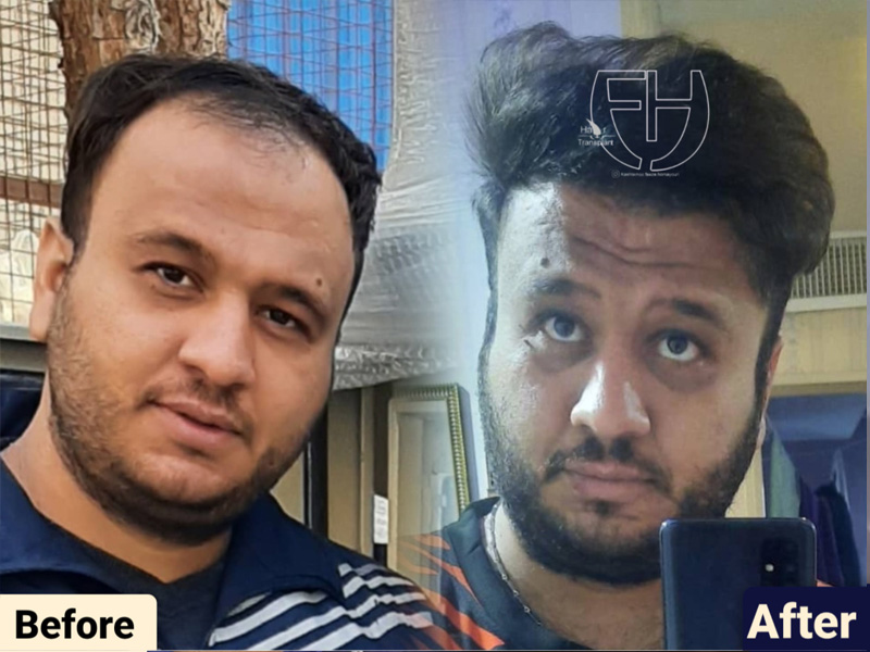 کاشت مو به روش fit و sut