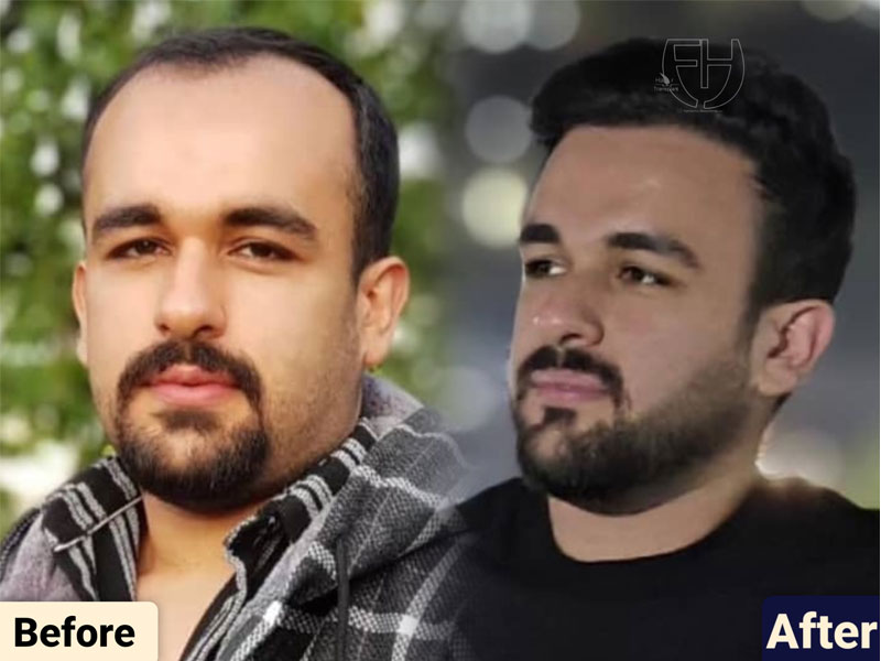 کاشت مو به روش fit و sut