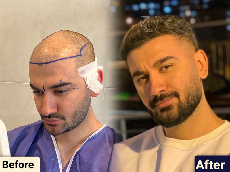 کاشت مو به روش fit