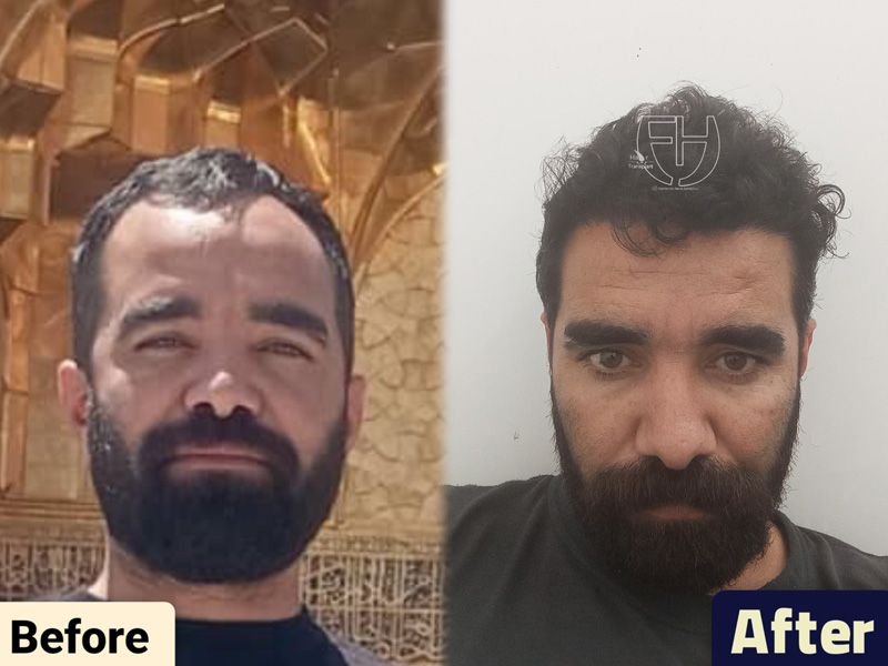 کاشت مو به روش fit