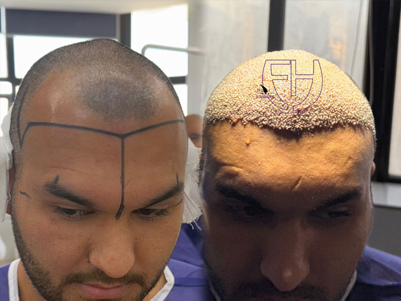 کاشت مو به روش fit و sut