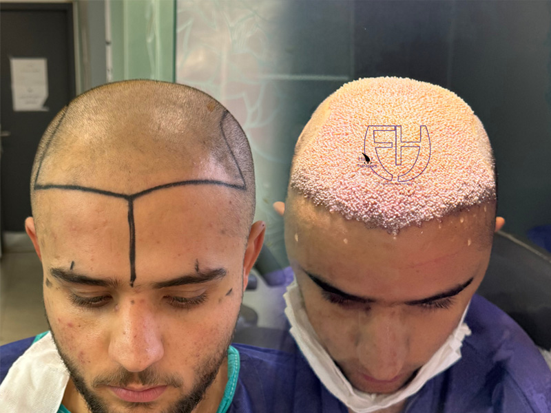 کاشت مو به روش fit