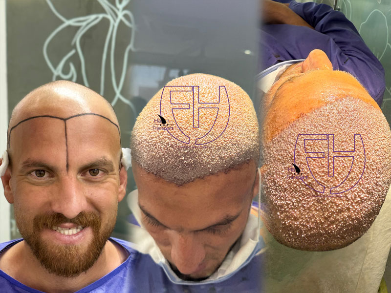 کاشت مو به روش fit و sut