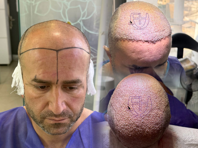 کاشت مو به روش fit و sut