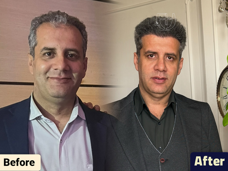 کاشت مو به روش fit