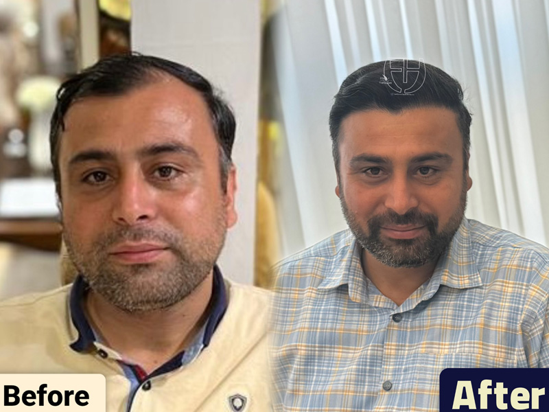 کاشت مو به روش fit و sut