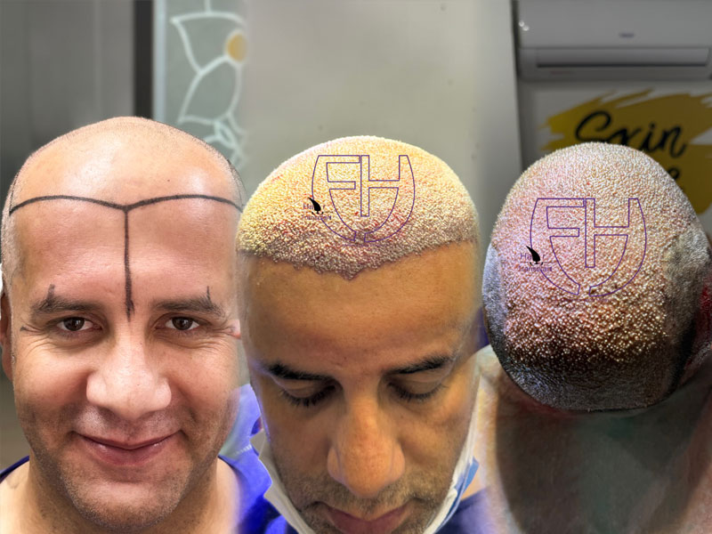 کاشت مو به روش fit و sut