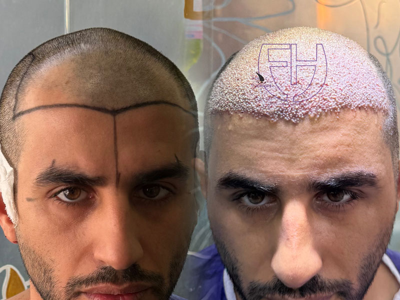 کاشت مو به روش fit