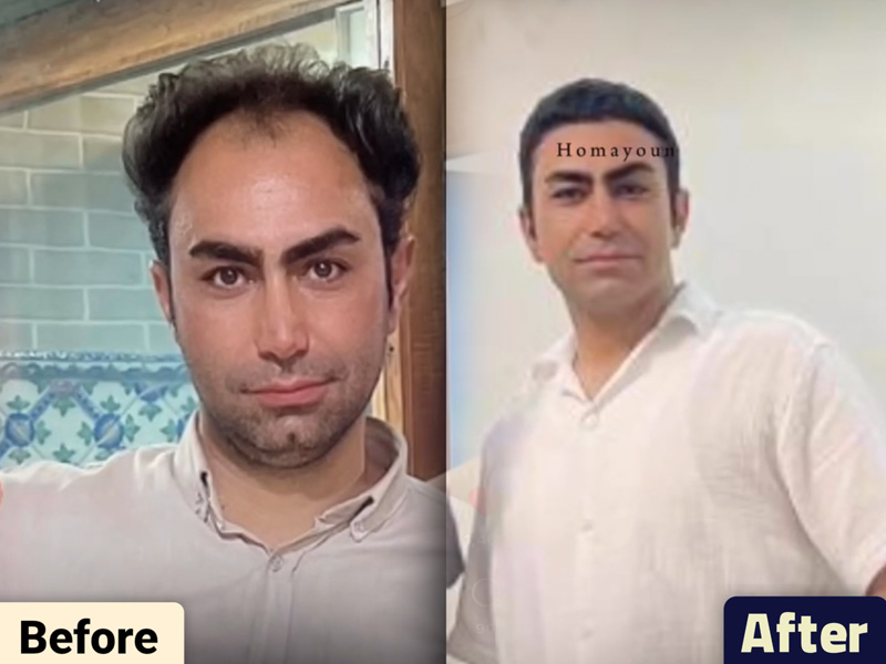 کاشت مو به روش fit و sut