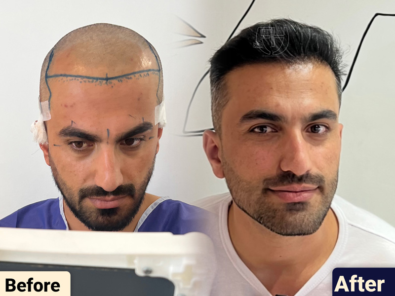 کاشت مو به روش fit و sut