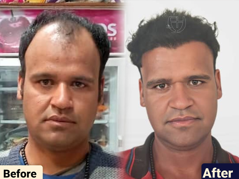 کاشت مو به روش fit