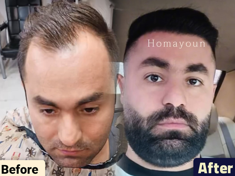 کاشت مو به روش fit