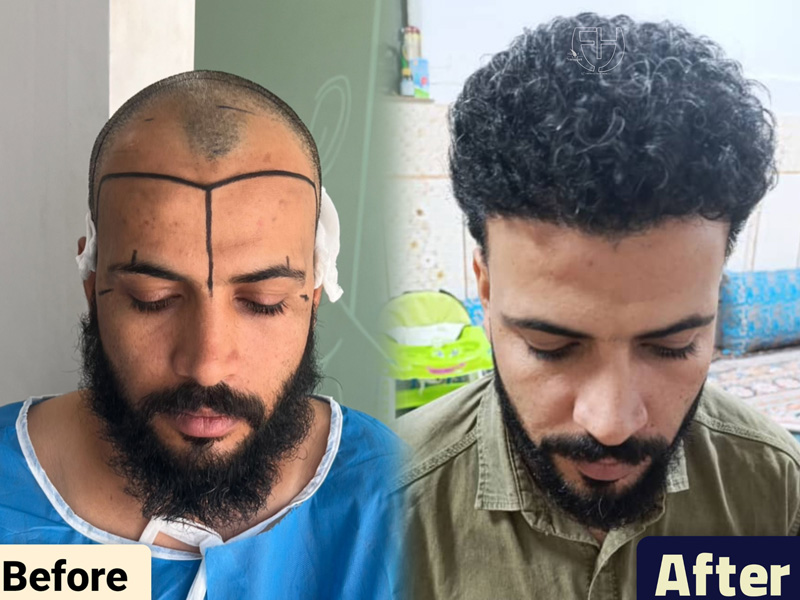 کاشت مو به روش fit و sut