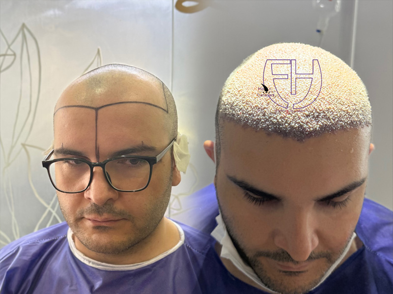 کاشت مو به روش fit و sut