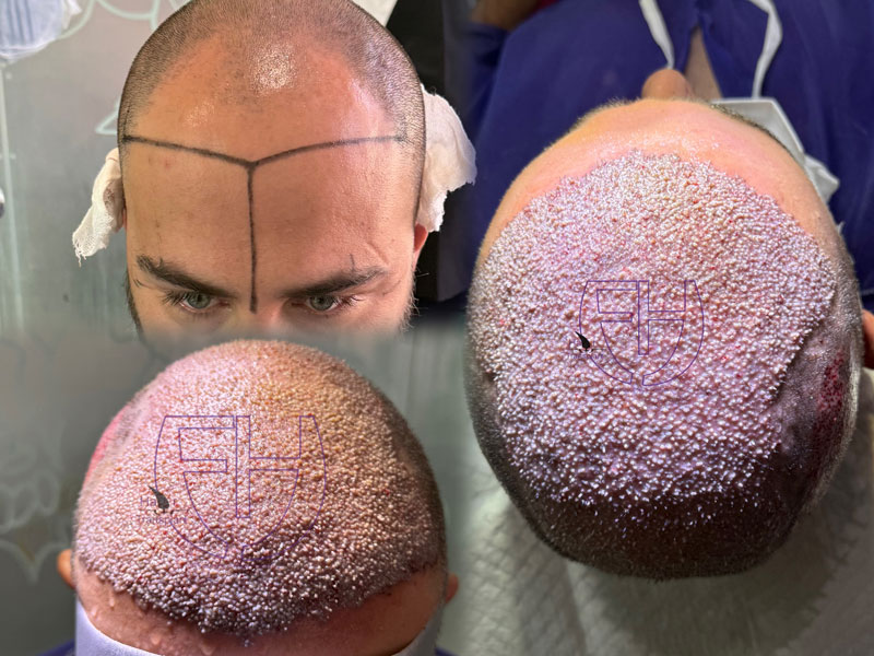 کاشت مو به روش fit