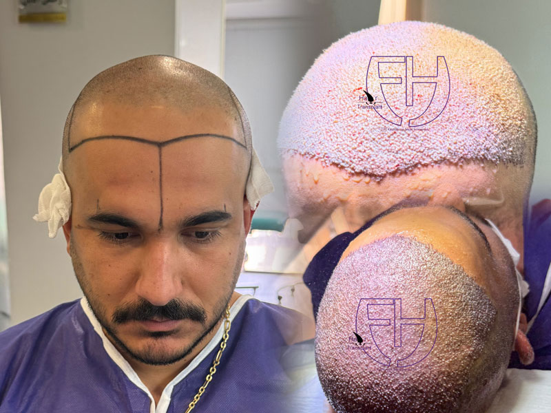 کاشت مو به روش fit و sut