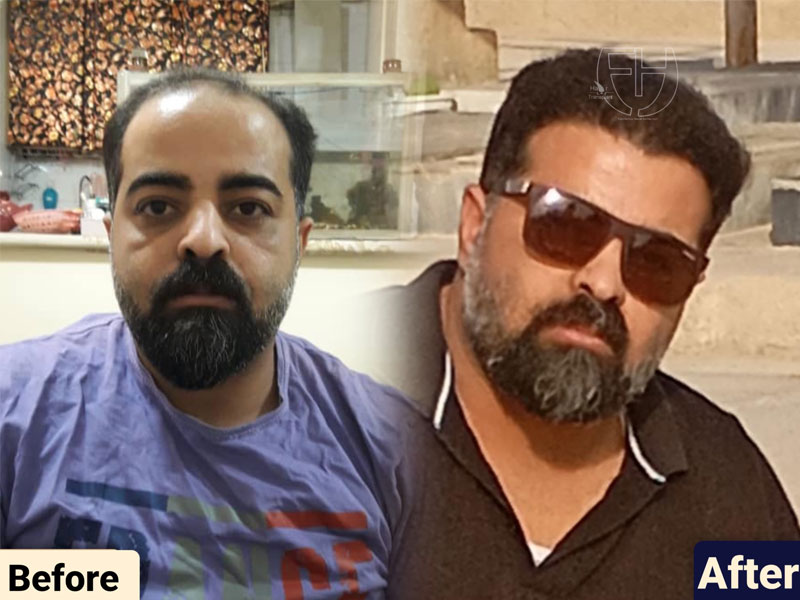 کاشت مو به روش fit و sut