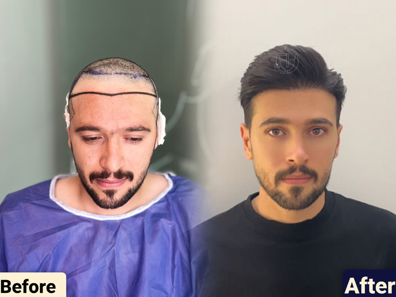 کاشت مو به روش fit و sut