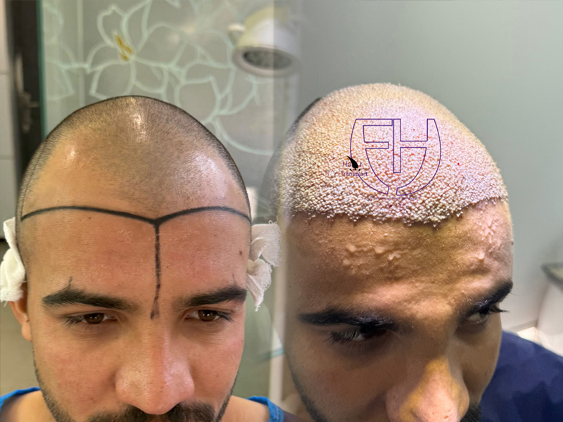 کاشت مو به روش fit و sut