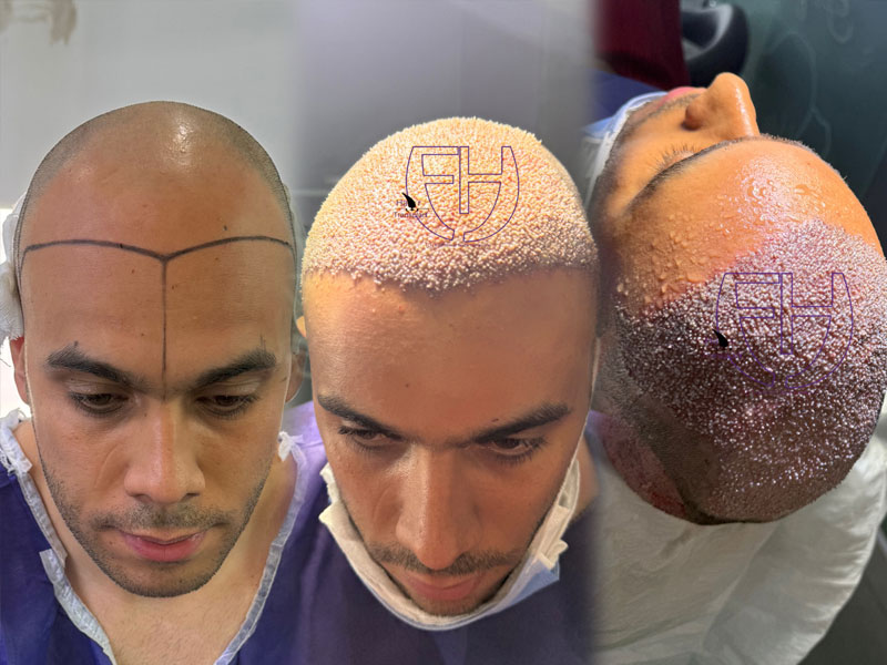 کاشت مو به روش fit و sut