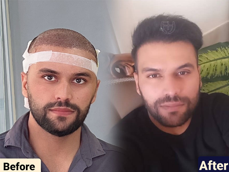 کاشت مو به روش fit