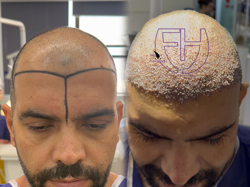 کاشت مو به روش fit