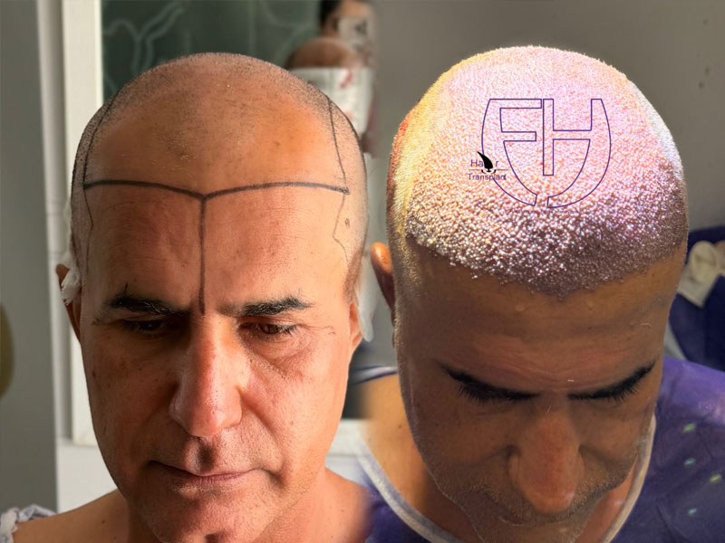 کاشت مو به روش fit