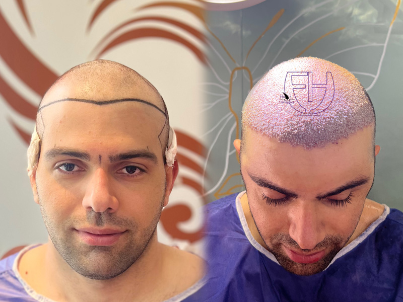 کاشت مو به روش fit