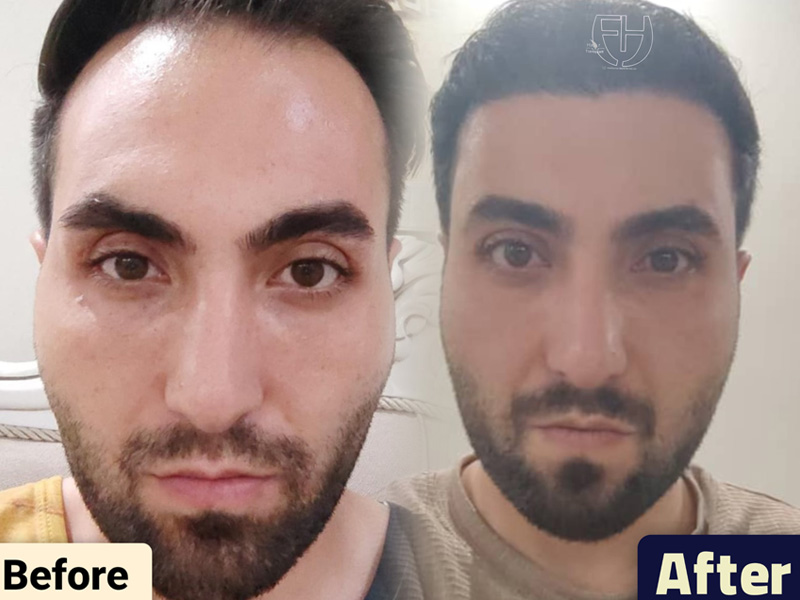 کاشت مو به روش fit و sut